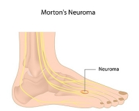 Where Is the Pain From Morton’s Neuroma Felt?