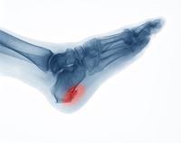 Heel Spurs and The Plantar Fascia