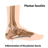 What Can I Do to Prevent Plantar Fasciitis?